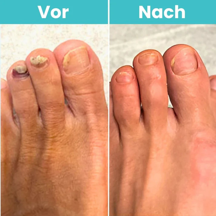 MycoCare™ - Laser-Nagelpilz-Behandlung Gerät