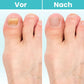 MycoCare™ - Laser-Nagelpilz-Behandlung Gerät