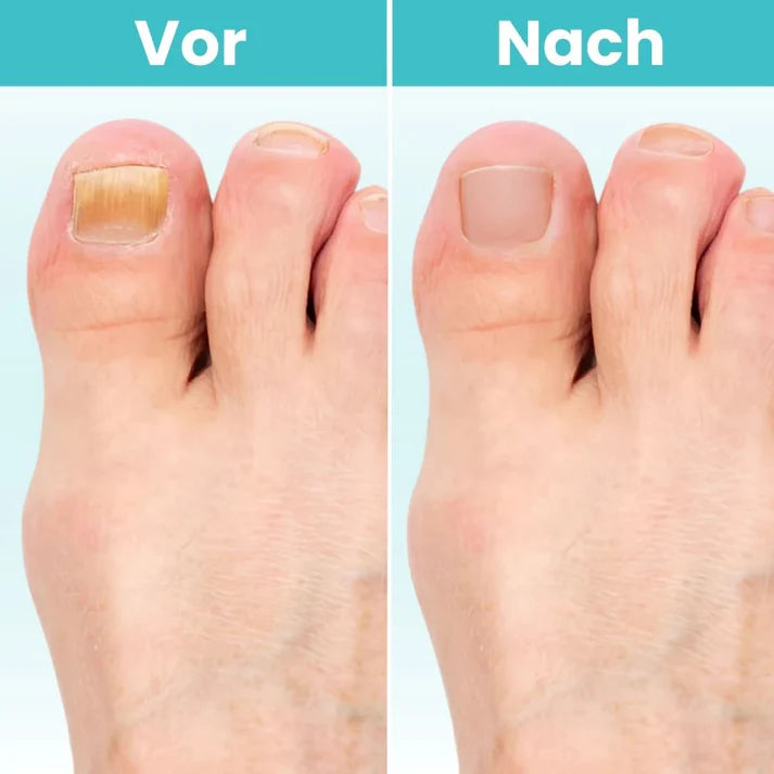 MycoCare™ - Laser-Nagelpilz-Behandlung Gerät