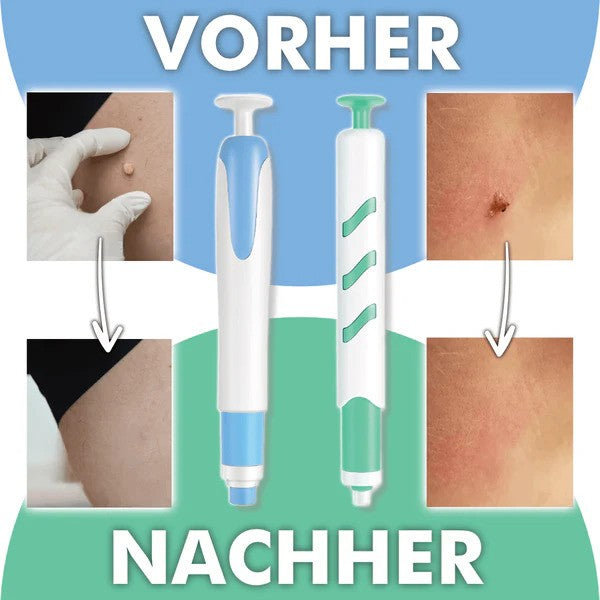 Novasta Warzenfrei PRO - Der Professionelle Stielwarzen Entferner