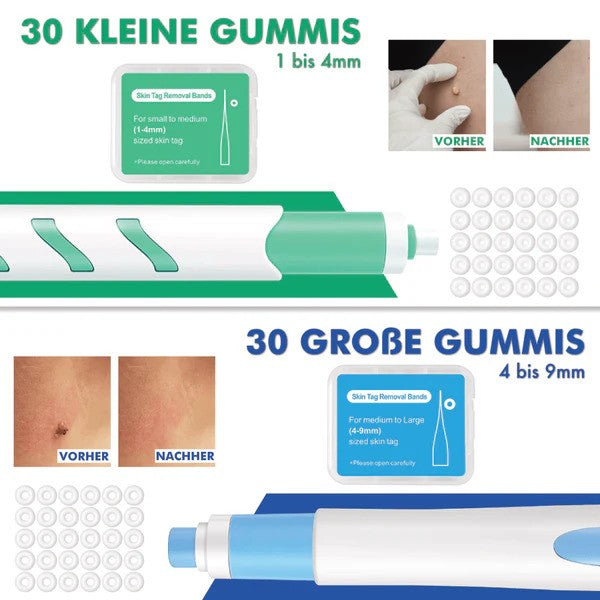 Novasta Warzenfrei PRO - Der Professionelle Stielwarzen Entferner